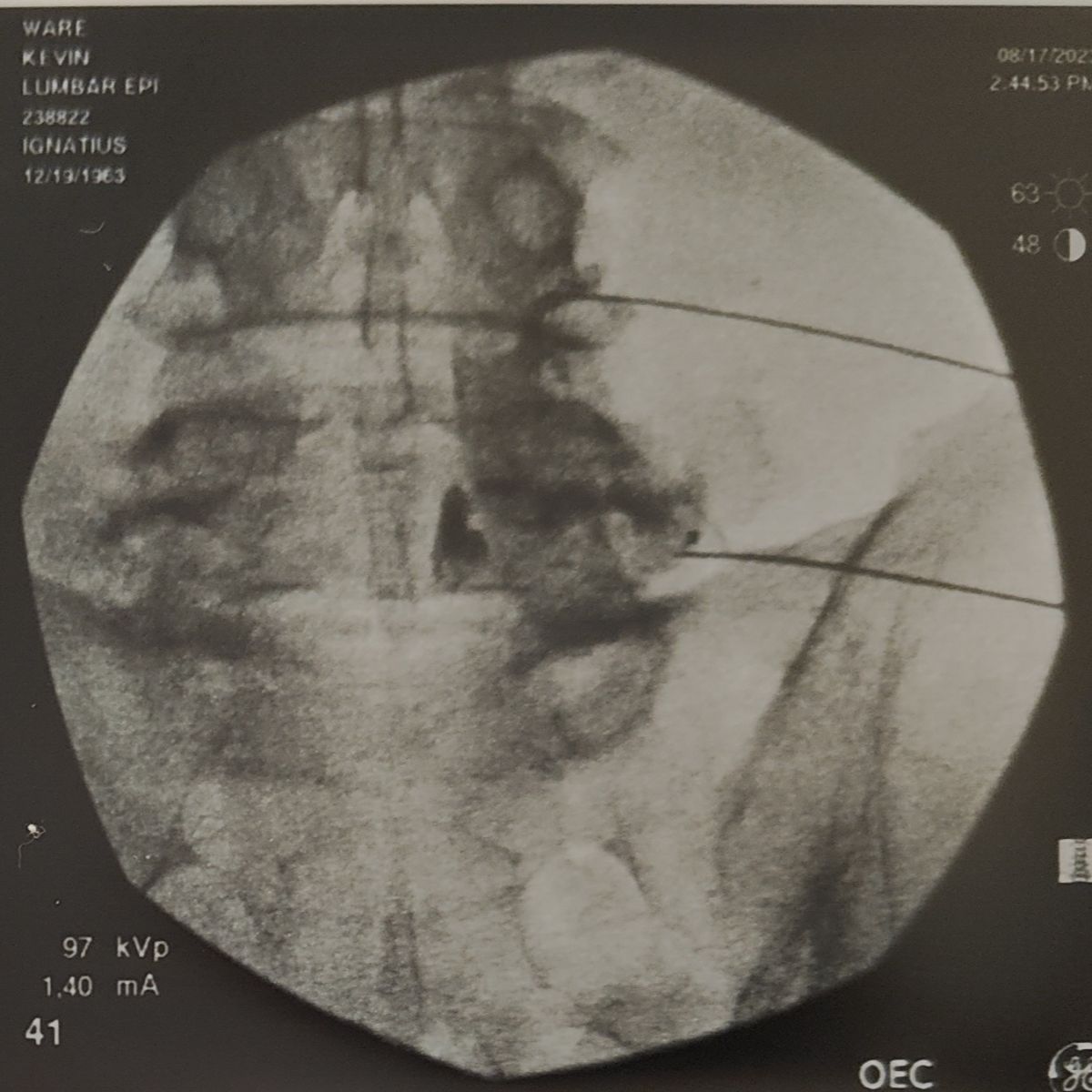 Spinal column x-ray with two thin needles to administer and epidural